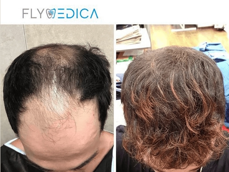 Dlaczego warto wybrać przeszczep włosów w Turcji z Flymedica? Odpowiadamy!