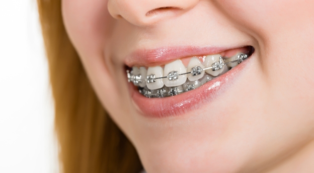 Proste zęby w każdym wieku – czyli dlaczego warto nosić aparat ortodontyczny